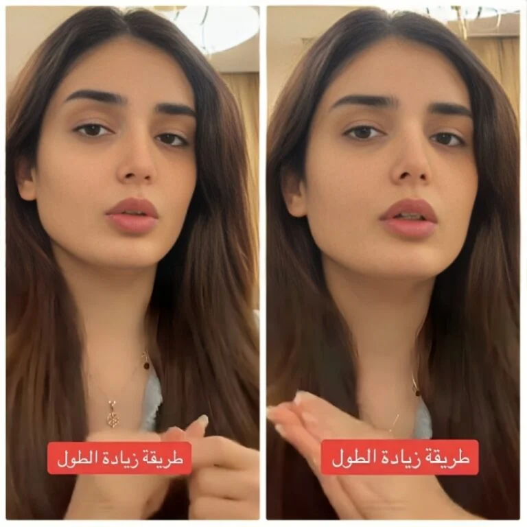 بالفيديو: عملية جراحية لزيادة طول فتاة سعودية الى 170 سم في الرياض تنتهي بمفاجأة 